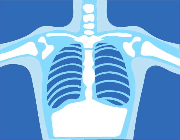 Chest X-ray